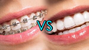 metal-bracers-vs-invisalign-bracers-straight-teeth-1024x575